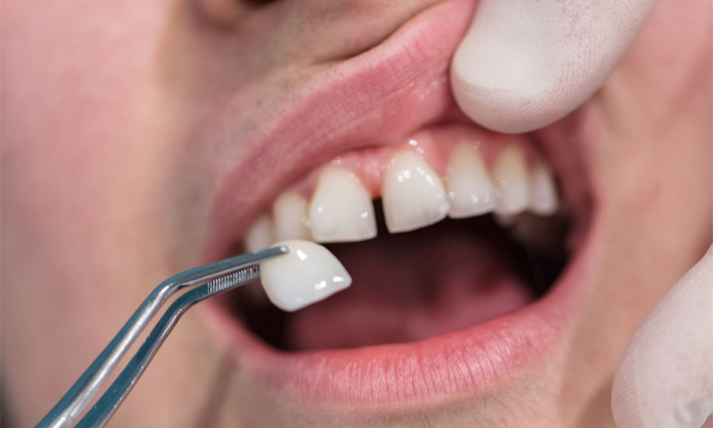 facette dentaire - Clinique Bernard Noël Beloeil et Saint-Basile-le-Grand